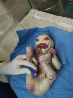 Bebé nacida sin piel